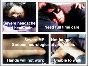 Severe ME is about Needing Care, Hands unable to work, feet unable to work, severe headache and headpain 